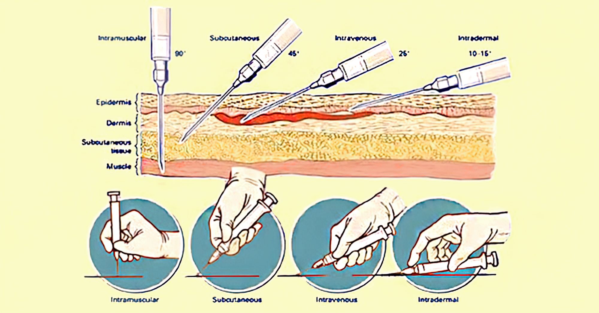 Места постановки внутрикожной инъекции. Внутримышечная инъекция угол введения иглы. Подкожная инъекция угол введения иглы. Угол введения иглы при внутримышечной инъекции. Техника постановки подкожной инъекции алгоритм.
