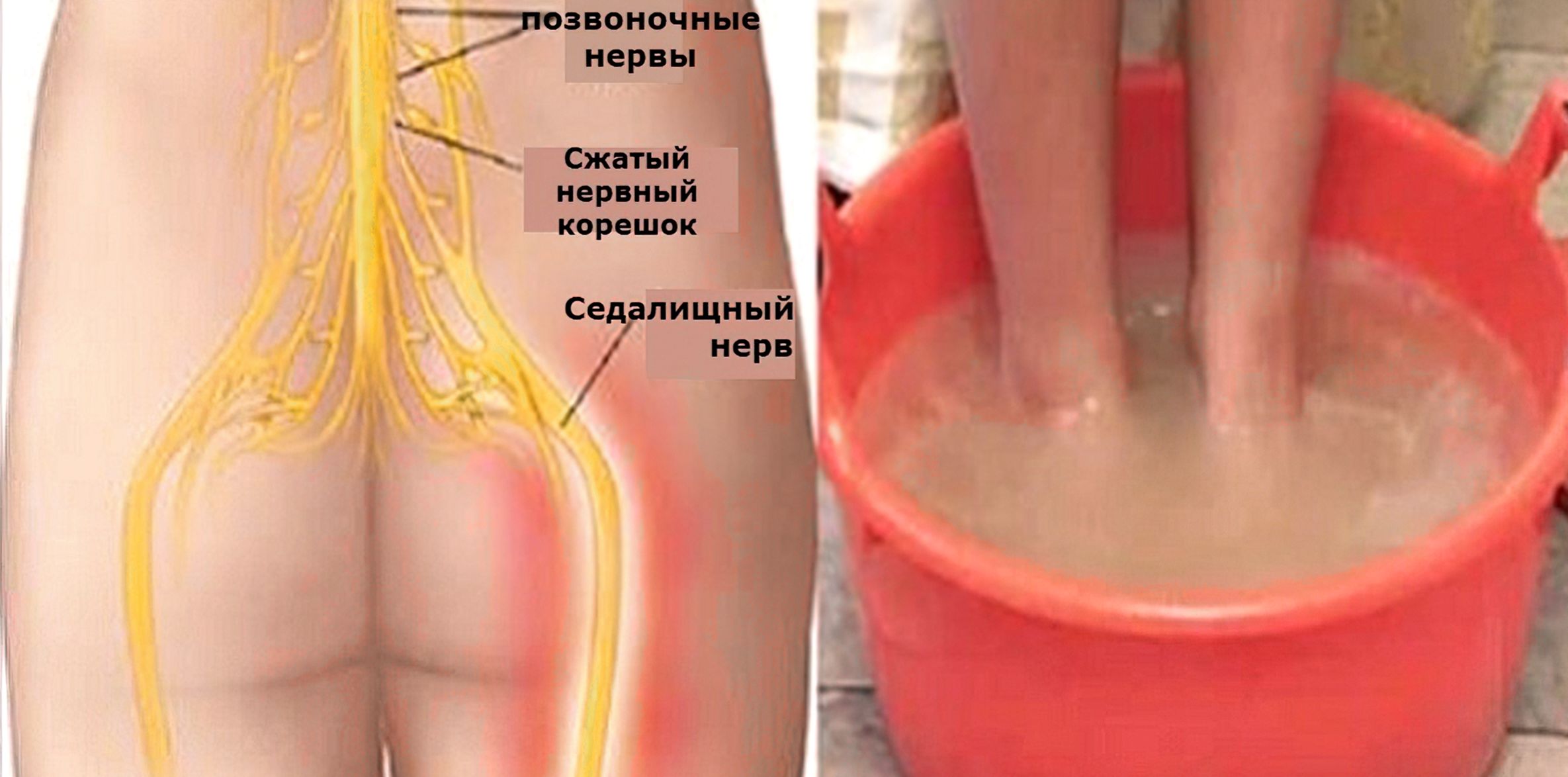 Воспаление нерва народными. Ишиас воспаление седалищного. Воспаление седалищного нерва. Седалищный нерв нерв. Седалищный нерв в ноге.